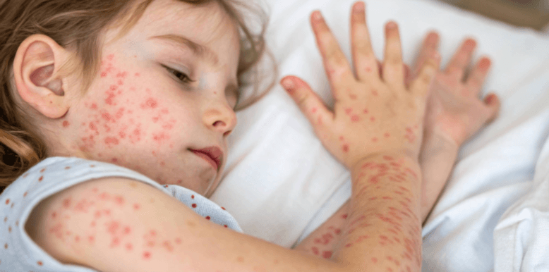 Measles Resurging in Canada – Why Vaccination Matters